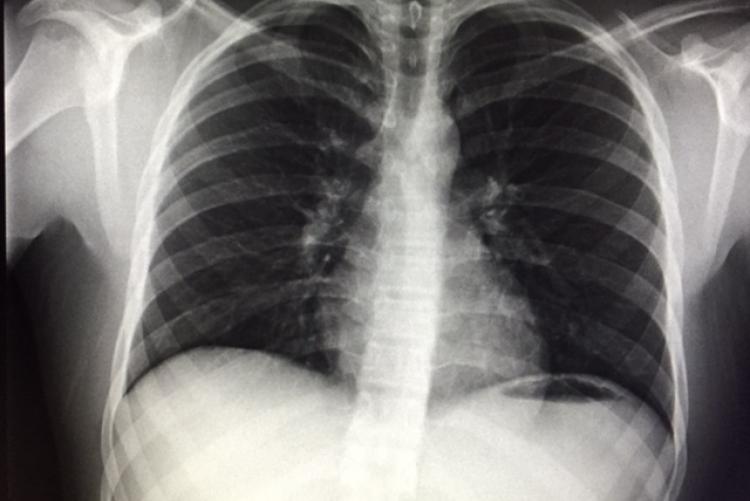 chest